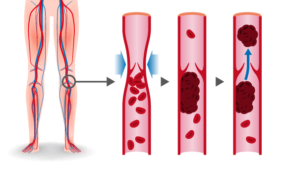 Thromboserisiko: Erhöht die Pille die Gefahr für ein Blutgerinnsel?
