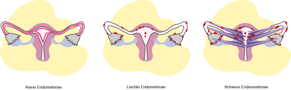 Endometriose Schweregrad