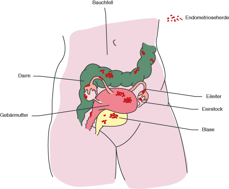 Die endometriose befindet sich meist am bauchfell im unteren bauchraum bzw....
