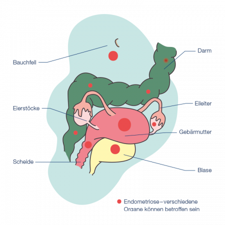 Organbefall bei Endometriose